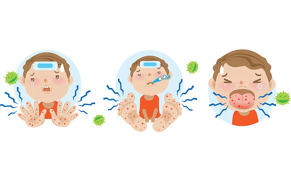 HAND, FOOT AND MOUTH DISEASE: causes, symptoms, treatment and prevention